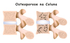 osteoporose5