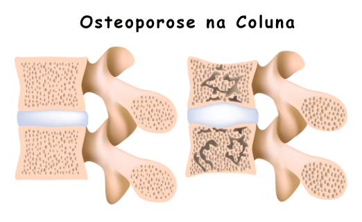 Osteoporose Na Coluna Clinica Bachmann Dr Elinton Bachmann